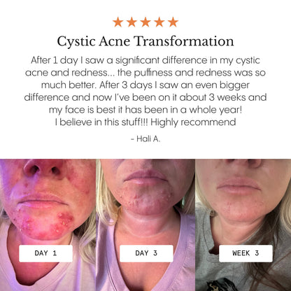 The Complete Acne System for Women